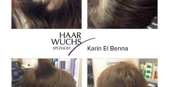 Kreisrunder Haarausfall - Kundenerfahrung mit YELASAI