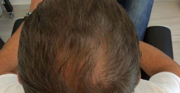 Geheimratsecken - Pflege mit YELASAI - Kundenerfahrung