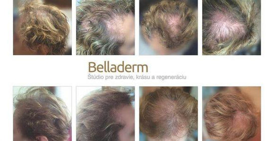 Schlechter Haarwuchs und irritierte Kopfhaut - Erfahrungsbericht