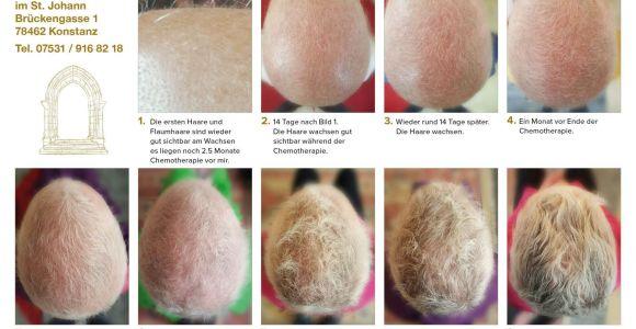 Haarausfall nach Chemotherapie - Kundenerfahrung