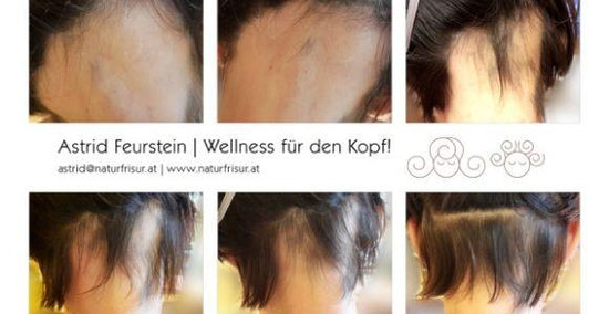 Alopecia Areata - Erfahrungsbericht über YELASAI