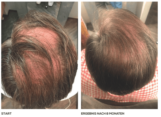 Glatzenbildung beim Mann – Ergebnis nach 8 Monaten