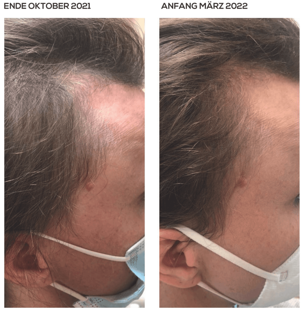 Stumpfe Haare und Geheimratsecken - Pflege mit Yelasai