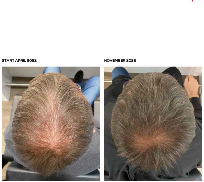 Androgenetischer Haarausfall beim Mann