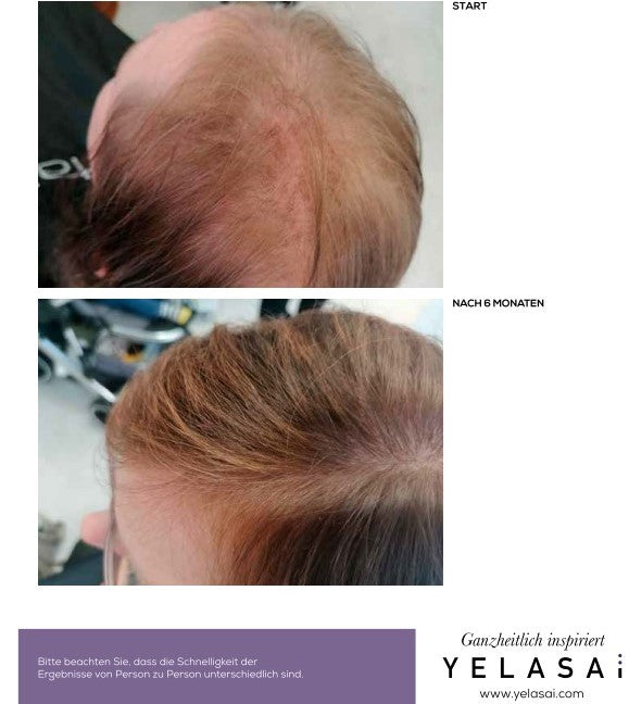 Diffuser Haarausfall bei der Frau