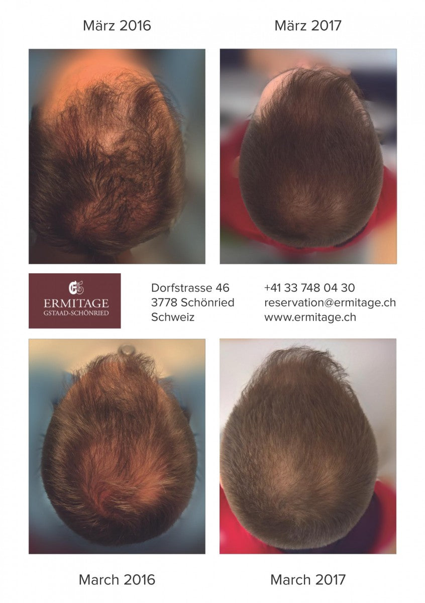 Erblich bedingter Haarausfall - Haarwuchs nach 12 Monaten