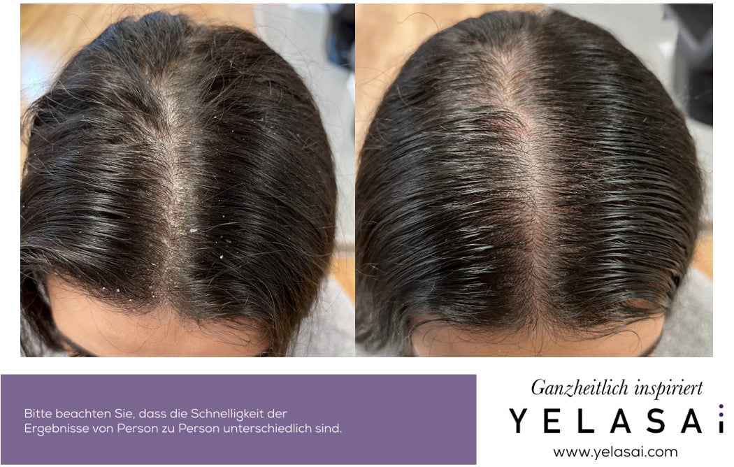 Juckende Kopfhaut mit Ablagerungen bei der Frau