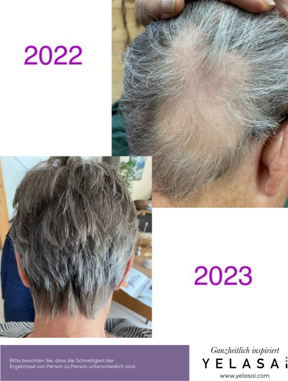 kreisrunder Haarausfall - Ergebnis Natur-Coiffure