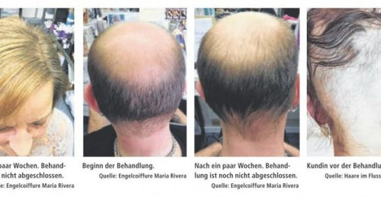 Kopfhautprobleme und Haarausfall - Erfahrungsbericht