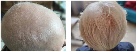 Scalp care for breast cancer image