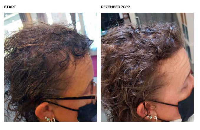 Minoxidil abgesetzt und aktiv die Kopfhaut gepflegt