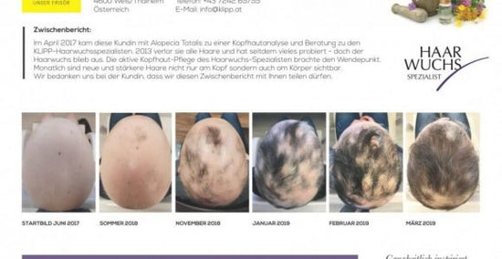 Totalhaarausfall - Neuer Haarwuchs mit YELASAI Pflege