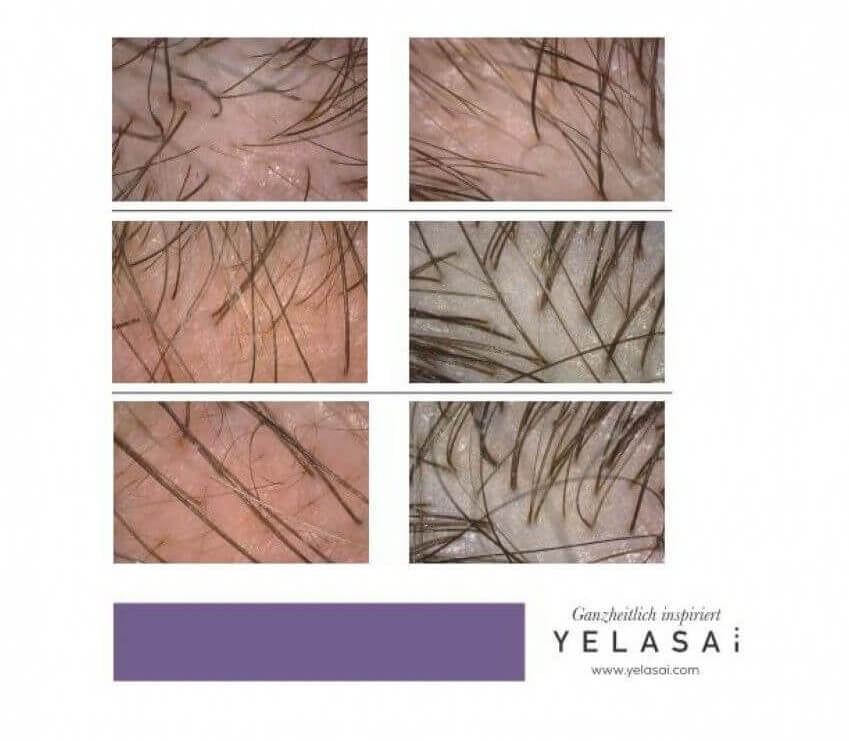 Unzufrieden nach Haartransplantation? YELASAI
