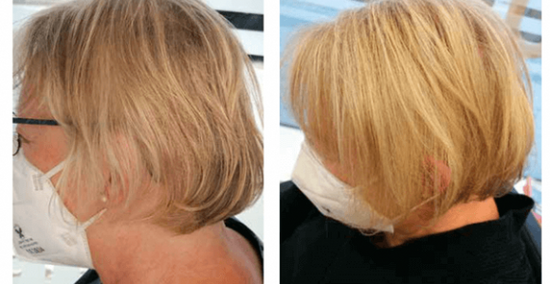 Verzweifelte Frau mit Haarausfall - Professionelle Haarpflege mit Yelasai