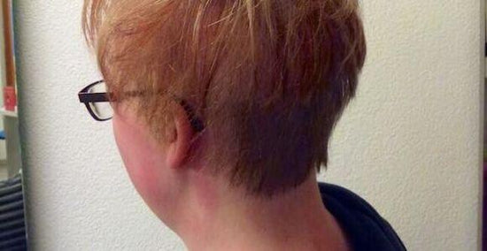 Haarlose Stellen am Kopf seit Geburt - Erfahrungsbericht