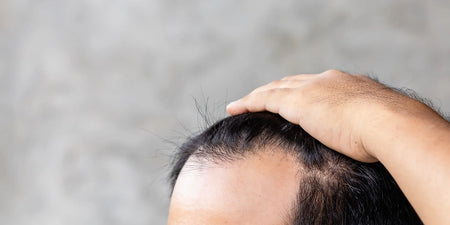 Perte de cheveux diffuse : symptômes, causes et traitement image