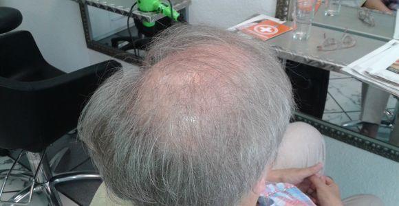 Haarausfall bei Frauen - Erfahrungsbericht