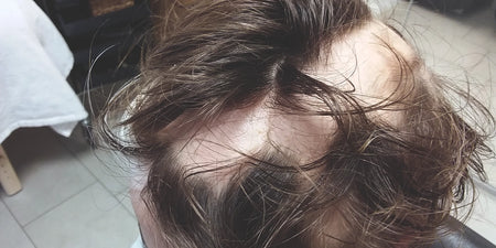 Alopecia areata: príčiny a liečba kruhového vypadávania vlasov image