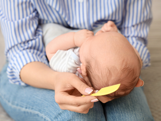 Milchschorf bei Babys – Ursachen, Pflege und sanfte Lösungen