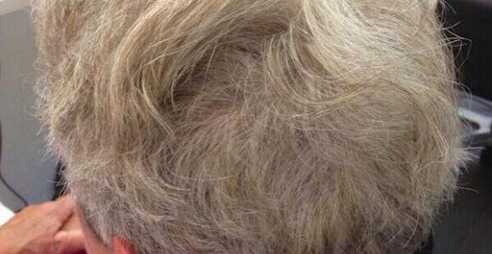 Alopecia Areata natürlich pflegen - Erfahrungsbericht