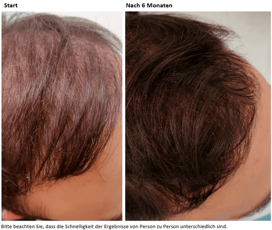 Androgenetischer Haarausfall bei einem jungen Mann nach 6 Monaten