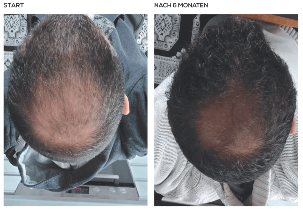 Haarausfall beim Mann - Kopfhautpflege bei Haarkranz