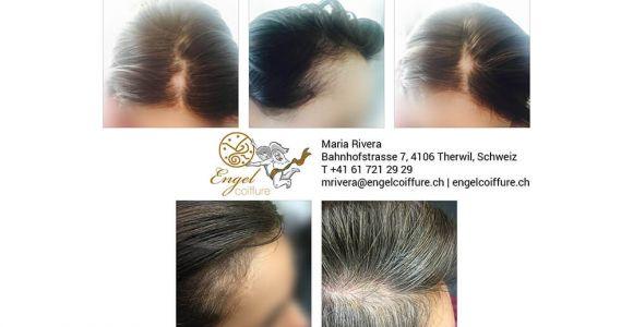 Geheimratsecken und kahle Stelle - Erfahrungsbericht