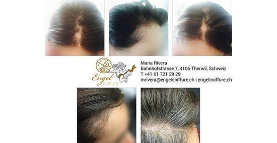 Geheimratsecken und kahle Stelle - Erfahrungsbericht