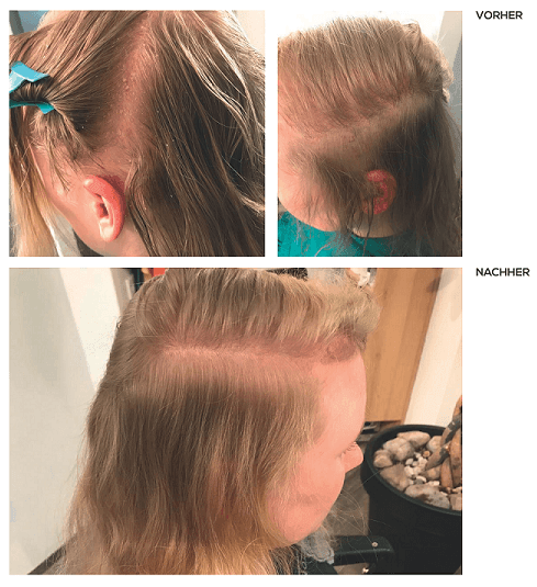 Starker Haarausfall und Kopfhaut Belag bei junger Frau - Ergebnis