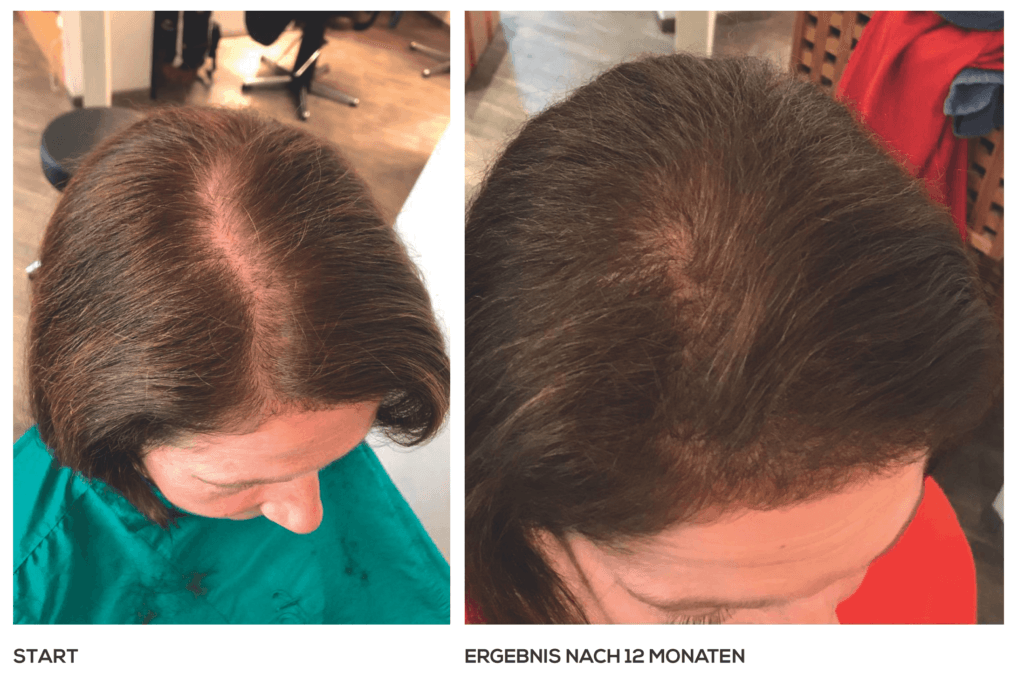 Diffuser Haarausfall bei der Frau - Ergebnis nach 12 Monaten