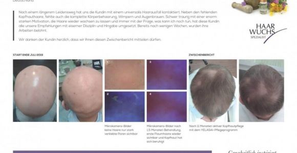 Alopecia Universalis - Pflege mit YELASAI Produkten