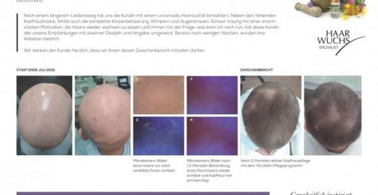 Alopecia Universalis - Pflege mit YELASAI Produkten