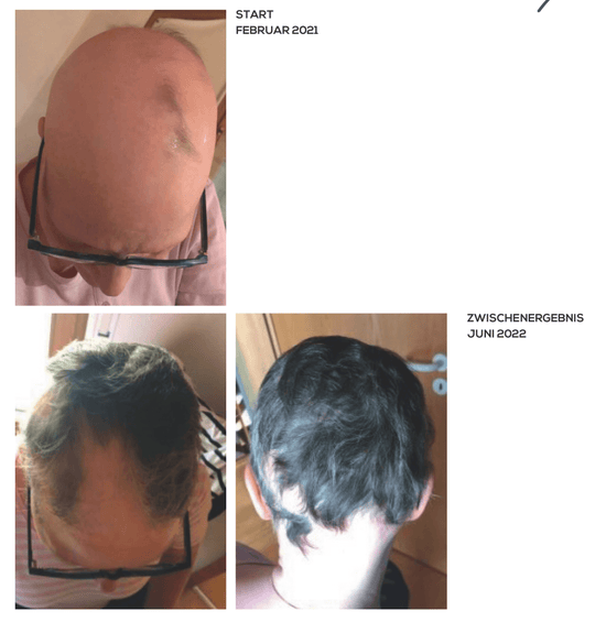 Alopecia Universalis oder kompletter Haarausfall