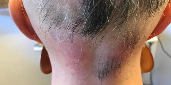 Erfahrung: Haarausfall bei Kopfhaut-Entzündungen oder -Flechten