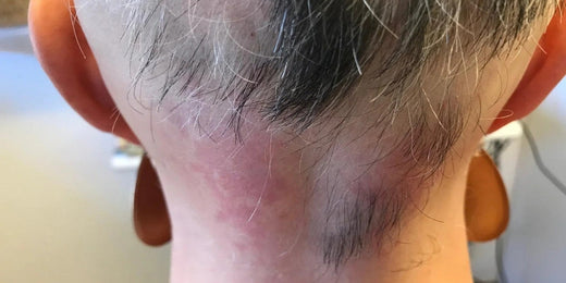 Expérience : Chute de cheveux en cas d'inflammations ou de dartres du cuir chevelu