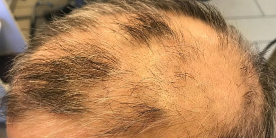Erfahrung: kahle Löcher im Haar oder vollständiger Haarverlust