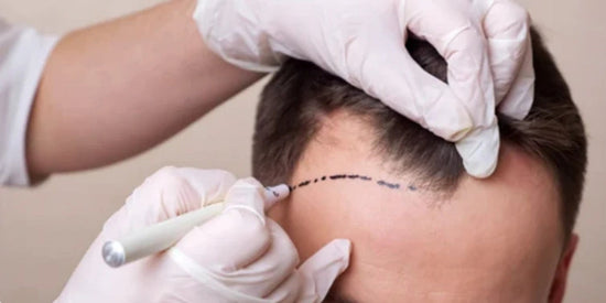 Erfahrung: Haarausfall trotz Haartransplantation