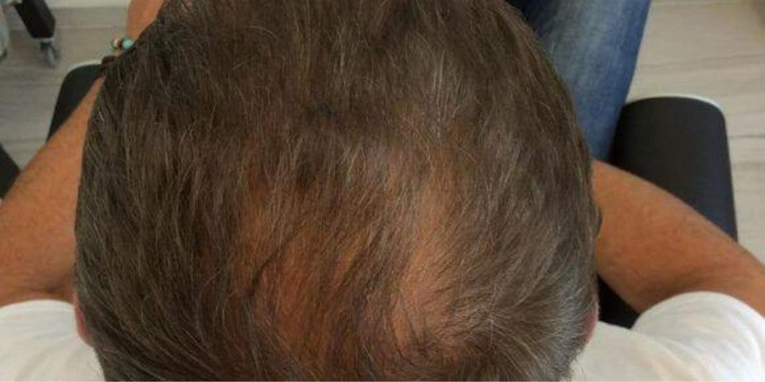 Erfahrung: dünner werdendes oder kraftloses Haar