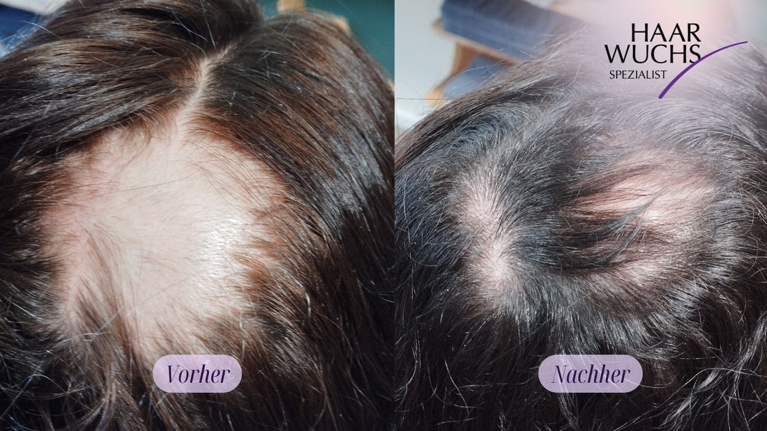 Kreisrunder Haarausfall (Alopecia areata): Erfahrung mit Cortison