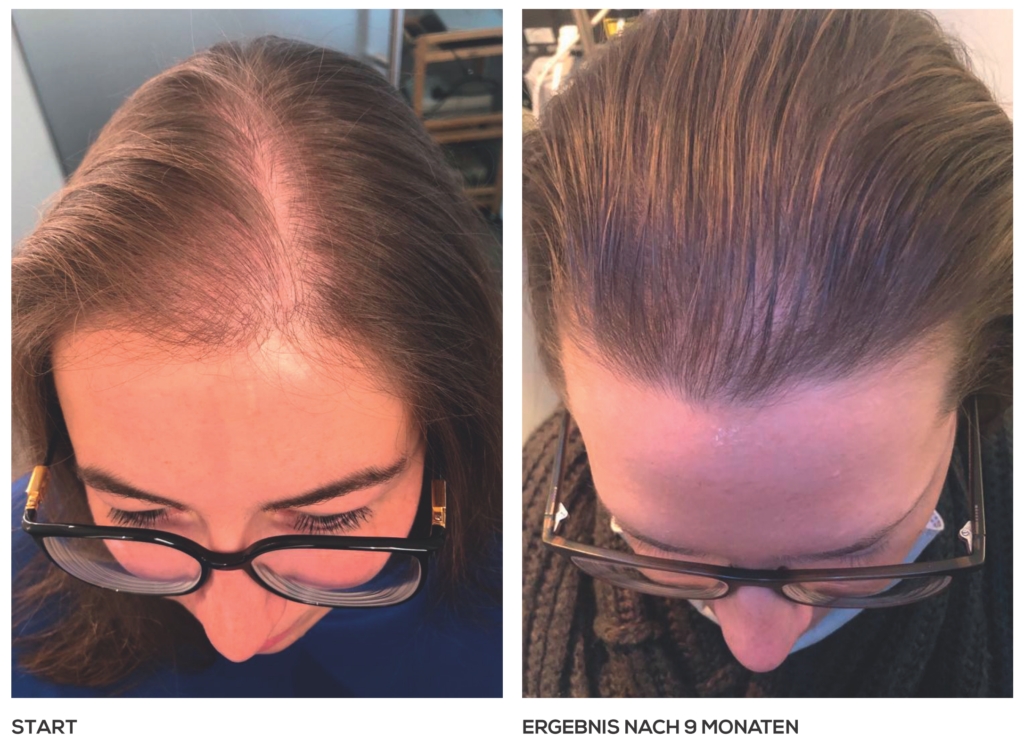 Diffuser Haarausfall bei der Frau nach 9 Monaten Yelasai Pflege – YELASAI