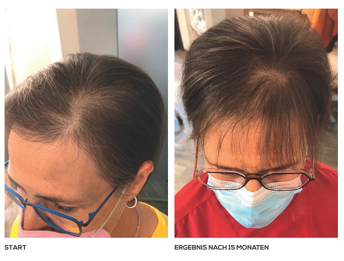 Dünnes Haar und verspannte Kopfhaut – Ergebnis nach 15 Monate