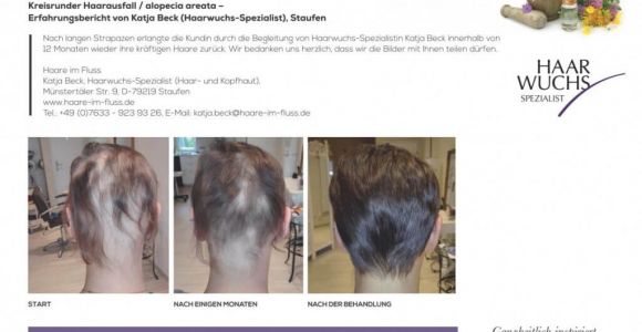 Haarwuchs nach Alopecia Areata (Kreisrunder Haarausfall)