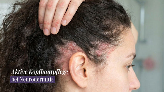 Neurodermitis auf der Kopfhaut: Erfahrungen mit aktiver Pflege