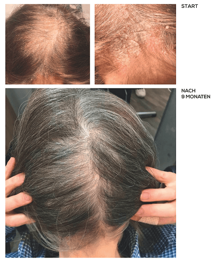 Schuppenflechte – Ergebnis nach 9 Monaten Kopfhautpflege