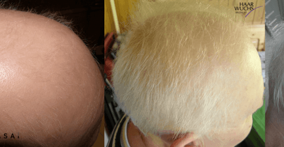 Alopecia Universalis - Haare wachsen wieder bei Kundin