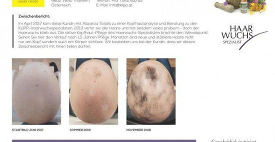 Haarwuchs trotz Alopecia Totalis (Totalhaarausfall)