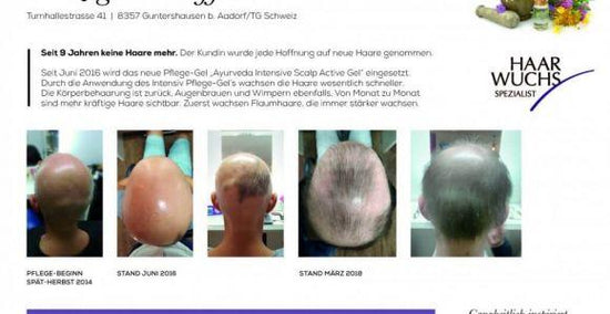 Haarwachstum trotz Total Haarausfall - Erfahrungsbericht