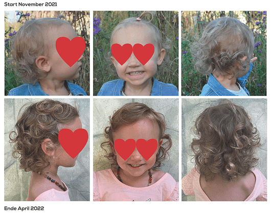 Kind mit schwachem Haarwuchs – Ergebnis nach 6 Monaten