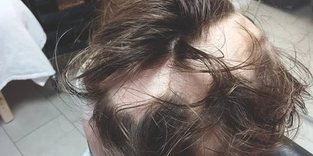 Ursachen & Behandlung von kreisrundem Haarausfall (Alopecia areata) image