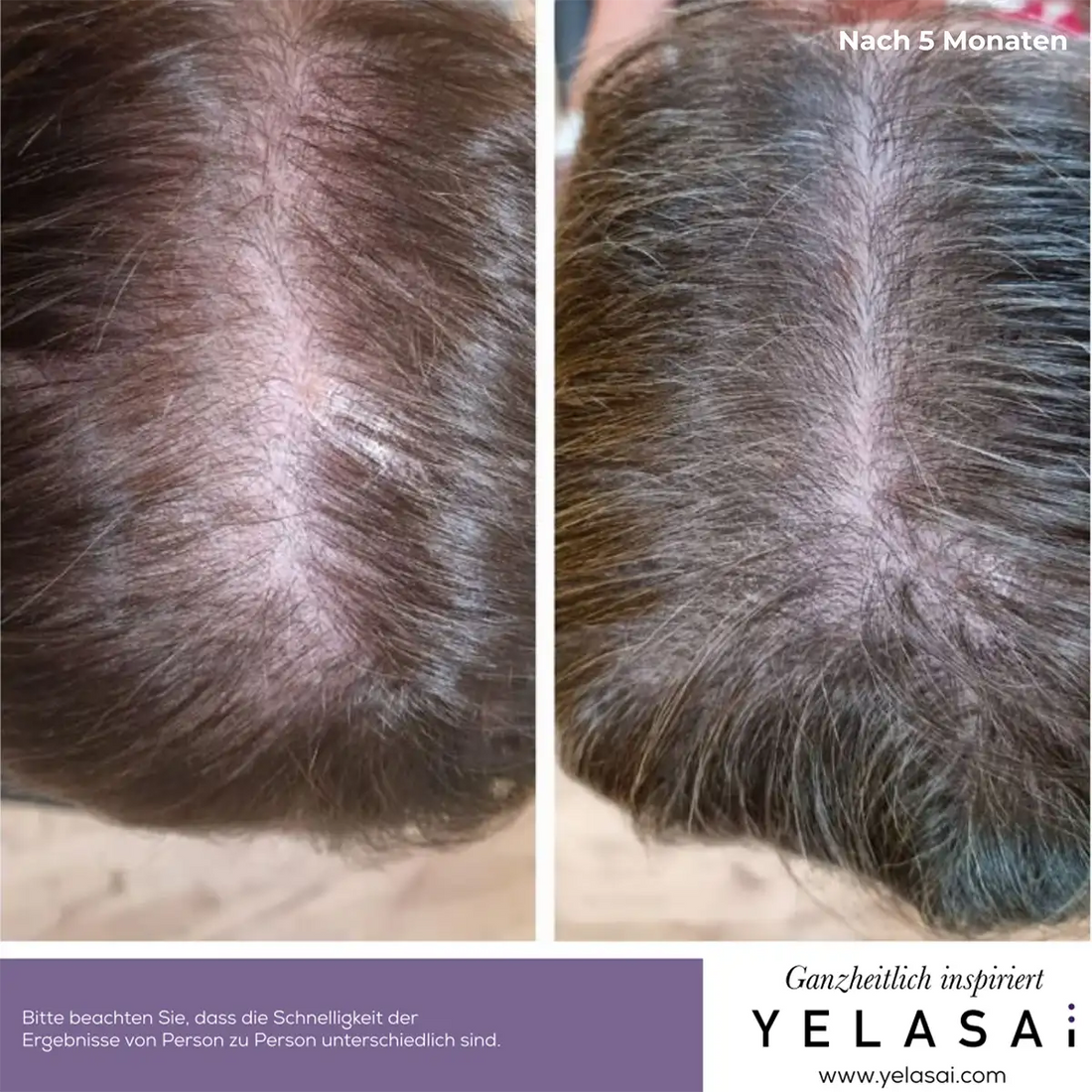 vitamine haarausfall